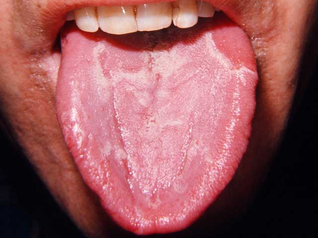 Desquamative Glossite