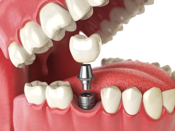 Implant installatie
