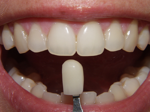 Wat zijn veneers