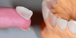 Hoe veneers op de tanden te plaatsen