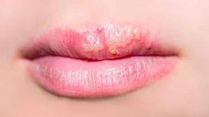 Soorten stomatitis