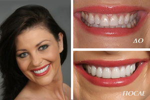Ceramische veneers