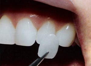 Fineerinstallatie Hollywood veneers