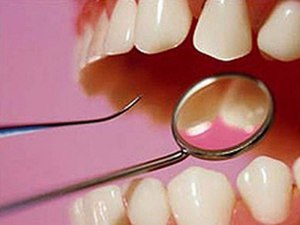 Preventie en behandeling van tandsteen Behandeling van tandsteen