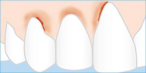Catarrale gingivitis Wat is gingivitis