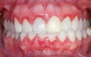 Waarom gingivitis optreedt