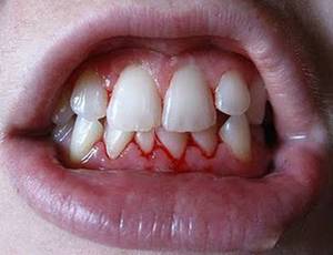 Gingivitis - ontsteking van het tandvlees Hoe gingivitis genezen