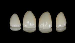 Zirconium fineer