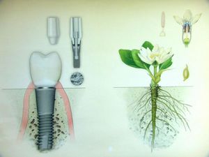 Typen tandheelkundige implantaten
