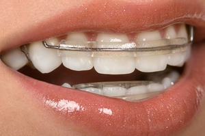 Type dentale doppen