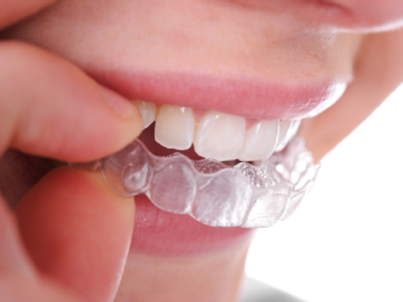 Capsules voor bijtcorrectie