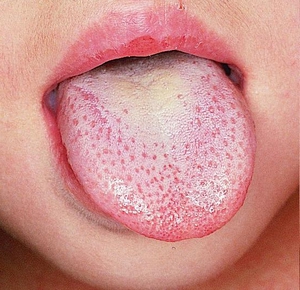 Witte plaque met infectie