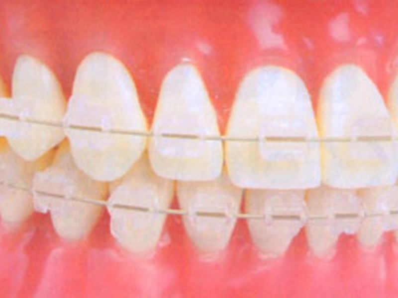 Transparante beugels Tandenbraces