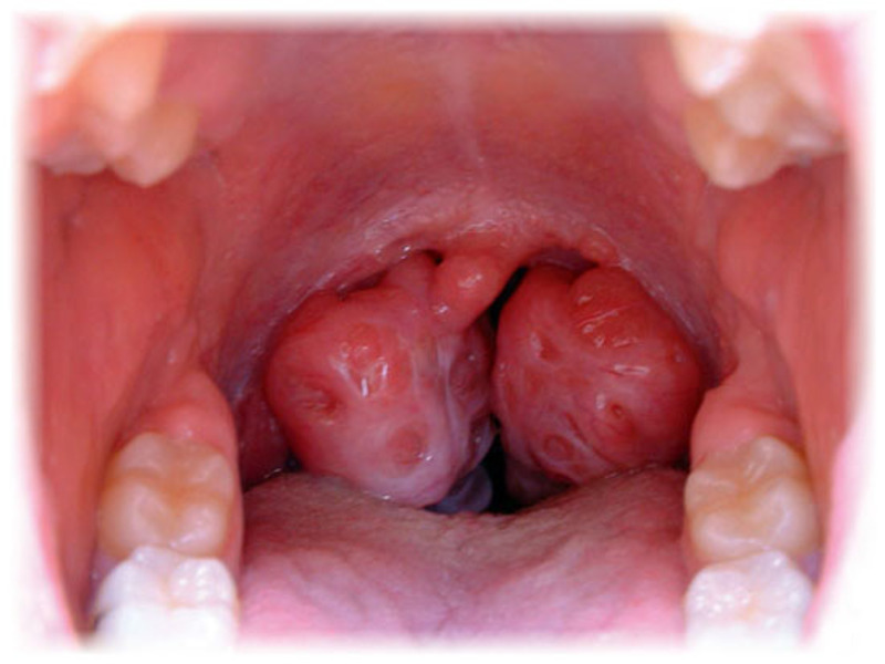 Diagnose en behandeling van chronische tonsillitis Witte pluggen voor chronische tonsillitis